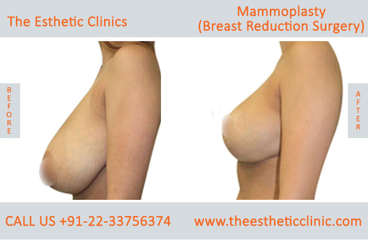 Mammoplasty, Breast Reduction Surgery before after photos in mumbai india (1)